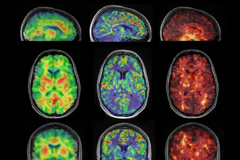 Examples of brain imaging from different angles. Bright colors show the varying levels of stiffness or softness in the brain.